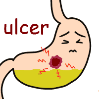 ulcer の意味 英語イラスト